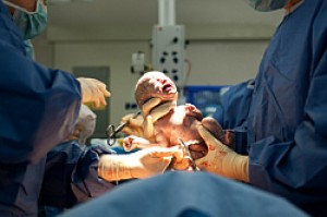 Nacięcie krocza podczas porodu
