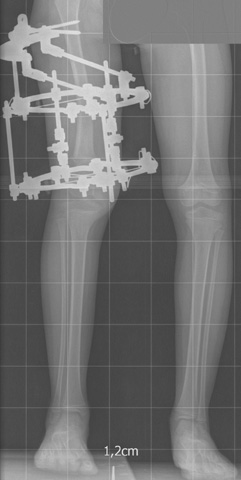 RTG tej samej kończyny w trakcie leczenia z zastosowaniem aparatu Ilizarowa