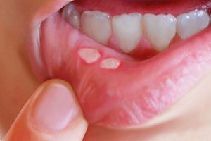Zakażenia drożdżakami w obrębie jamy ustnej